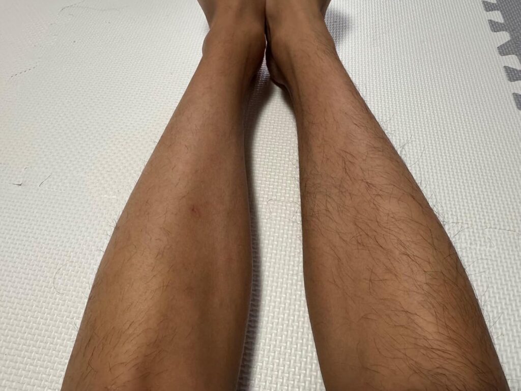 家庭用脱毛器PL7357の使用前後の脚の比較写真